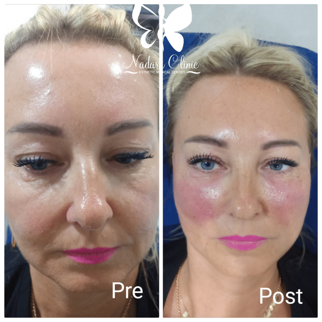 الخيوط الذهبية لشد الوجه بالغردقة